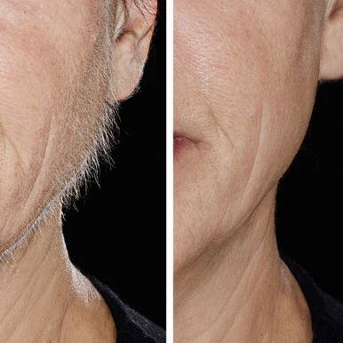 Hollywood Smoother, Replacement Heads- Rose Gold - Image 3