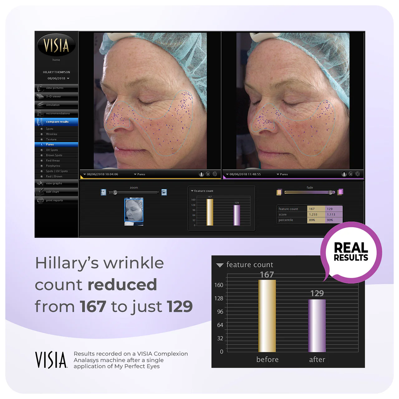 My Perfect Facial 5 Treatments - Image 8