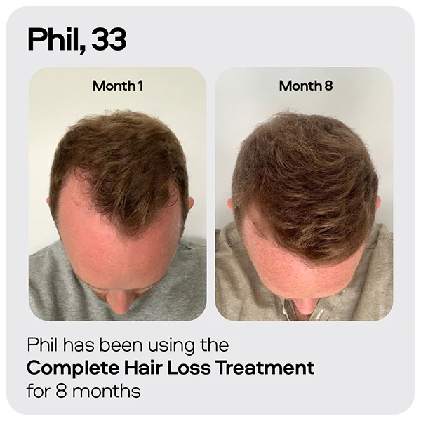 Sons Hair Loss Complete Set - Image 6